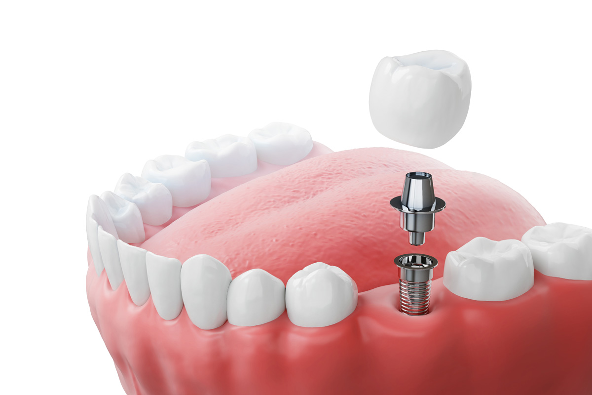 Dental implants