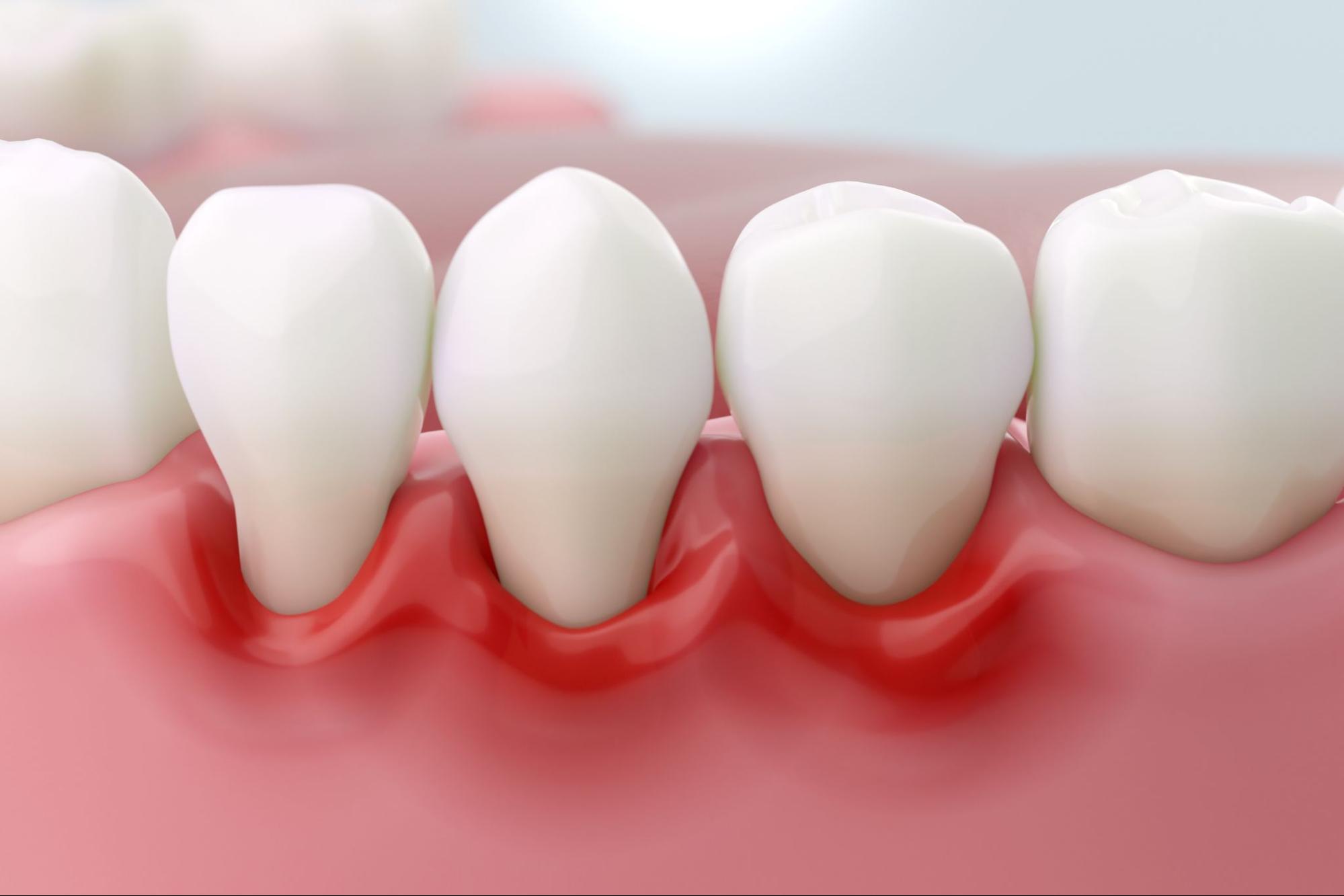 Gum Recession