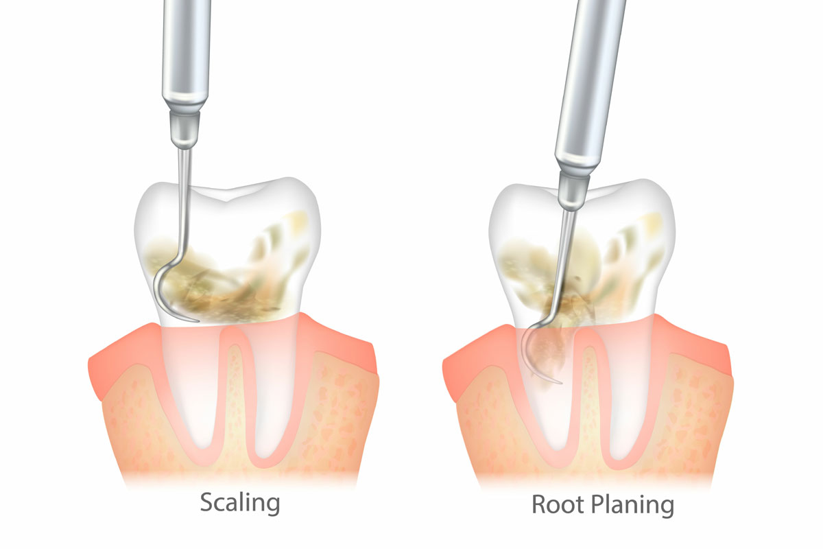 Scaling