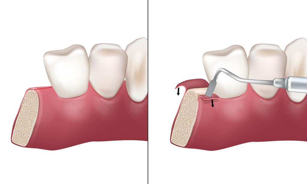 Mid-crestal incision used during implant bed preparation. Paracrestal Incision. Flap Techniques in Dentoalveolar Surgery. Periodontal