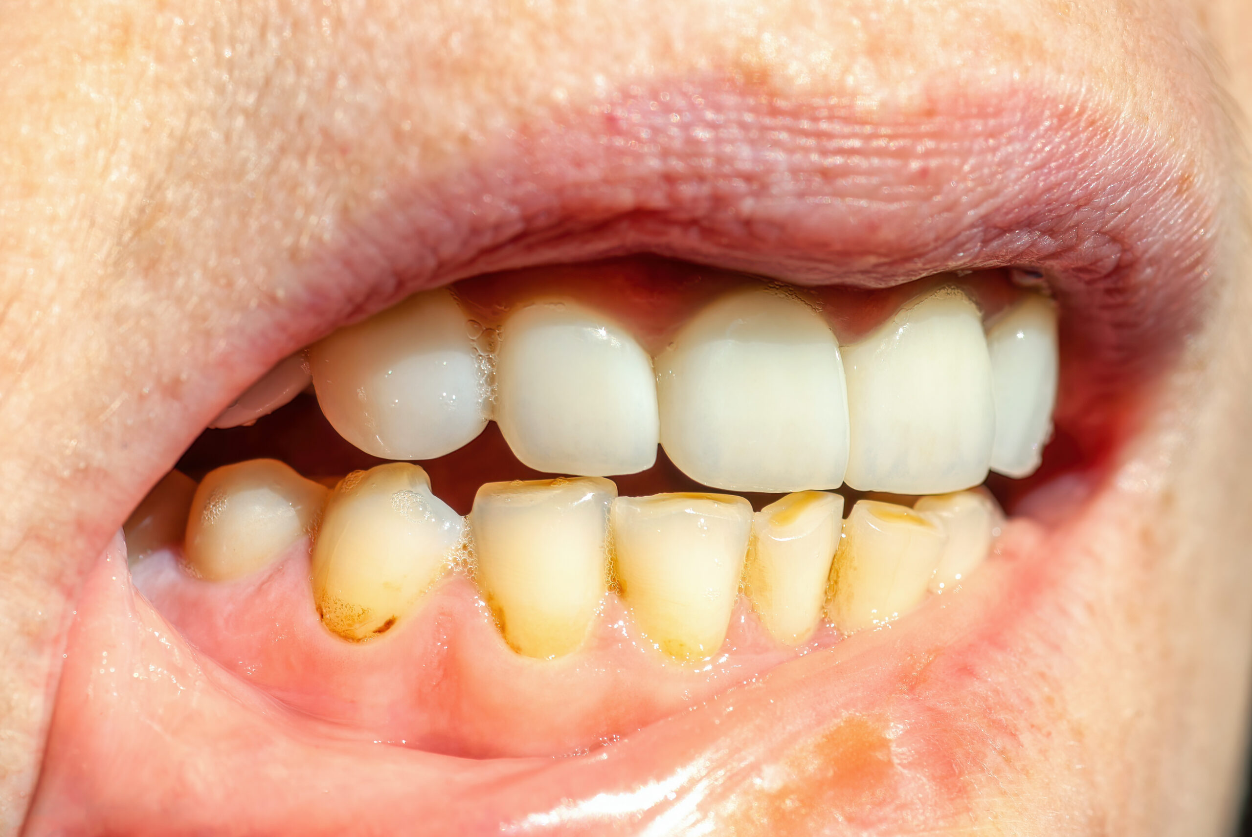 Dental calculus on teeth, sign of smoking habits. Bacterial plaque on smokers teeth