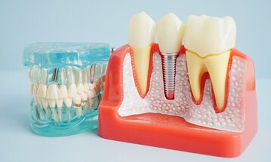 Dental implant model showing the tooth root and surrounding gum tissue