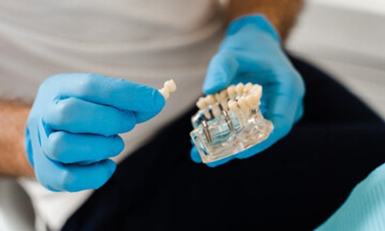 Dental implant model illustrating post-extraction healing timeline